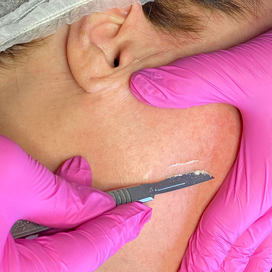 10 Gauge Dermaplaning knife over the skin