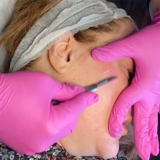 10 Gauge Dermaplaning knife over the skin