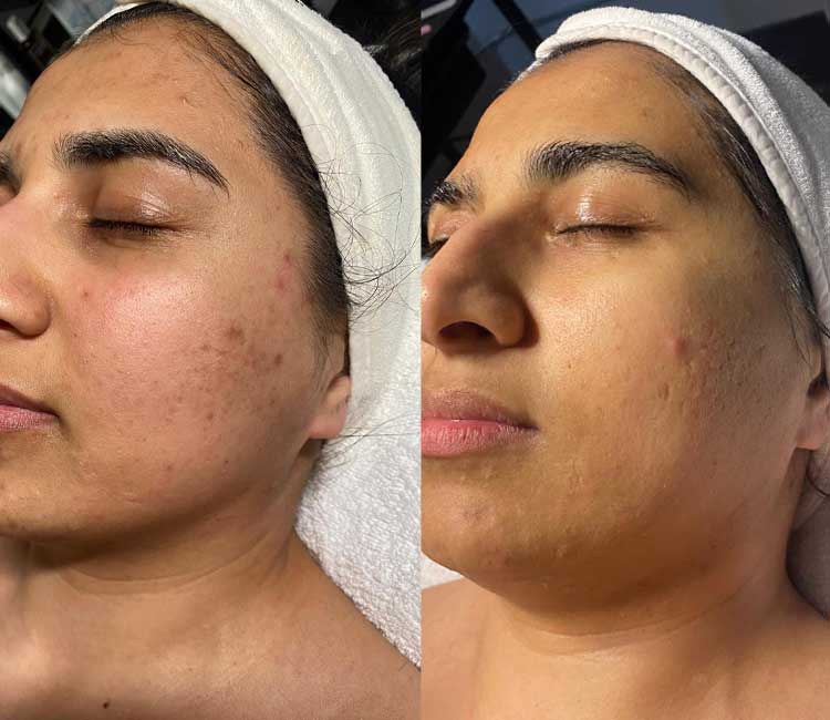 Before and after Facial