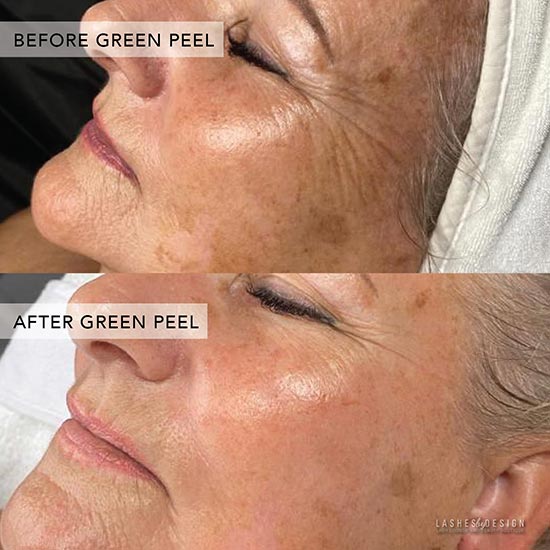 Before and after green peel